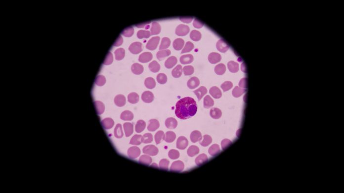 Immature Granulocytes Immature Granulocytes
